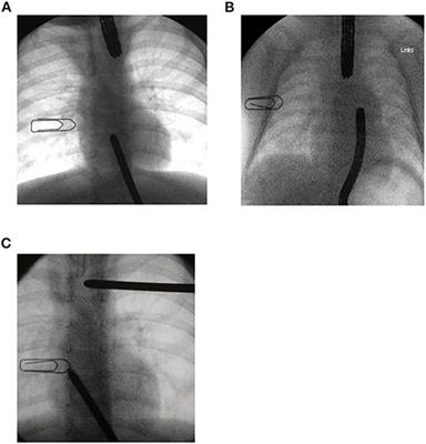 Favorable Outcome of Electively Delayed Elongation Procedure in Long-Gap Esophageal Atresia